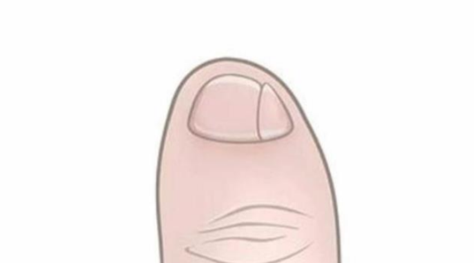 你的小拇指指甲是两瓣吗? - 足部知识 - 今彩慧·健康服务预约平台