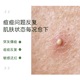 雪完美祛痘清颜修护精华液30ml_3